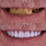 نتيجة قبل وبعد زراعة الأسنان All-on-4 في Excelentis Dental Center، استعادة الابتسامة