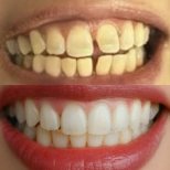 نتائج قبل وبعد ابتسامة هوليود في Excelentis Dental Center، أسنان بيضاء ومتناسقة