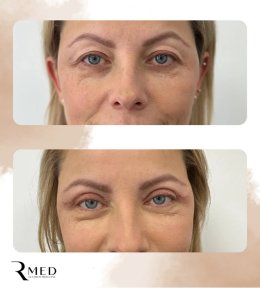 Résultats avant/après blépharoplastie chez Rmed Kopernika, correction visible des paupières supérieures