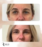 Résultats avant/après blépharoplastie chez Rmed Kopernika, correction des paupières