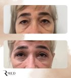 Résultats avant et après blépharoplastie chez Rmed Kopernika, correction des paupières