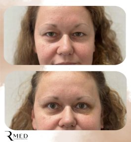 Résultats avant et après blépharoplastie chez Rmed Kopernika, correction des paupières