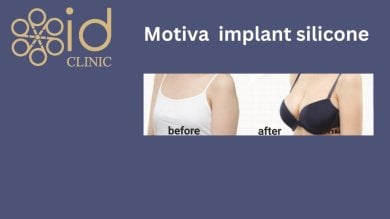 До и после увеличения груди с имплантами Motiva в ID Clinic Bangkok, видимый результат