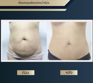 Resultados de abdominoplastia antes y después en Asia Cosmetic Hospital, mejora abdominal visible