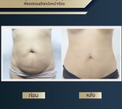 Resultados de abdominoplastia antes y después en Asia Cosmetic Hospital, mejora abdominal visible
