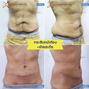 Resultados de abdominoplastia antes y después en Asia Cosmetic Hospital, piel abdominal firme