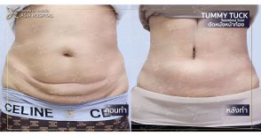 Fotos de antes y después de Levantamiento de senos tomadas por el Dr.(la Dra.) 