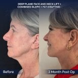 Efekty przed i po liftingu twarzy i szyi w Dr. Safa Manav Clinic, widoczne odmłodzenie