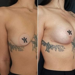 Vorher-nachher-Ergebnis Bruststraffung bei Private Yüzyıl Hospital, verbesserte Brustform