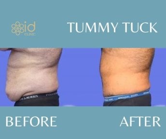 Resultados de abdominoplastia antes y después en ID Clinic Bangkok, mejora visible del abdomen