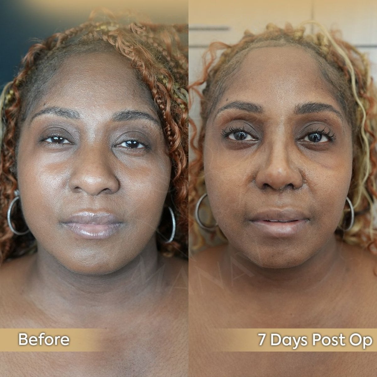 Resultados de rinoplastia étnica antes y después en Dr. Safa Manav Clinic, 7 días post-op