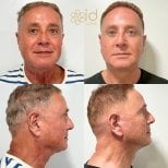 Vorher-nachher-Ergebnis Halsstraffung bei ID Clinic Bangkok, sichtbare Straffung von Hals und Kiefer