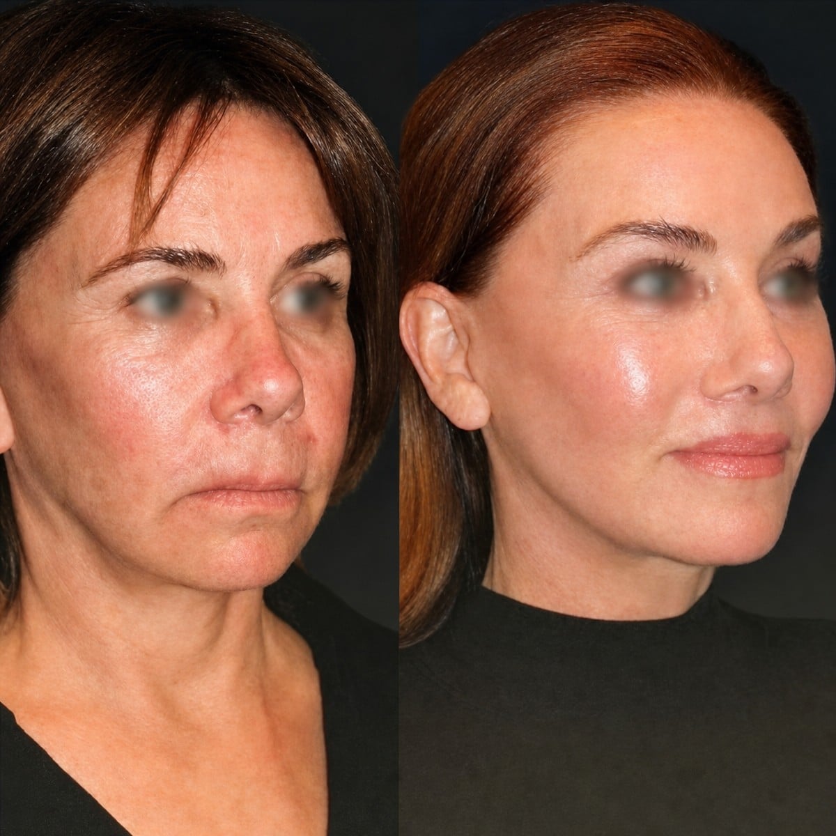 Resultados antes y después de lifting de cuello en Memorial Antalya Hospital, rejuvenecimiento facial