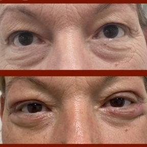 Before and after lower eyelid blepharoplasty results at DGB Clinic, reduced under-eye bags