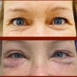 Before and after lower eyelid blepharoplasty results at DGB Clinic, reduced under-eye bags