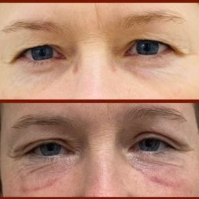 Lower eyelid blepharoplasty before and after results at DGB Clinic, under-eye rejuvenation