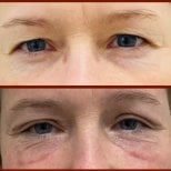 Lower eyelid blepharoplasty before and after results at DGB Clinic, under-eye rejuvenation