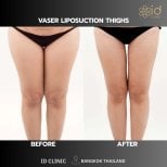 Фото до та після ліпосакції, доктор 