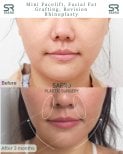 Résultats avant/après mini lifting, lipofilling, rhinoplastie secondaire chez SAERO