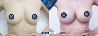 Before and after breast implant revision results at Asia Cosmetic Hospital, improved breast shape
