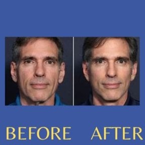 Before and after endoscopic facelift results at ID Clinic Bangkok, facial rejuvenation visible