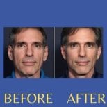 Before and after endoscopic facelift results at ID Clinic Bangkok, facial rejuvenation visible