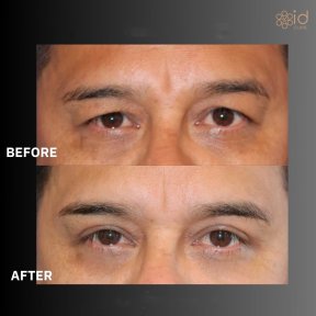 Before and after upper eyelid surgery results at ID Clinic Bangkok, rejuvenated eye appearance