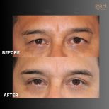Before and after upper eyelid surgery results at ID Clinic Bangkok, rejuvenated eye appearance