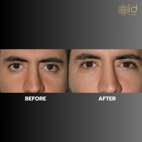 Before and after upper eyelid surgery results at ID Clinic Bangkok, improved eye appearance