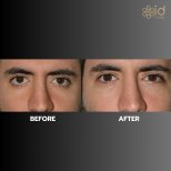 Before and after upper eyelid surgery results at ID Clinic Bangkok, improved eye appearance