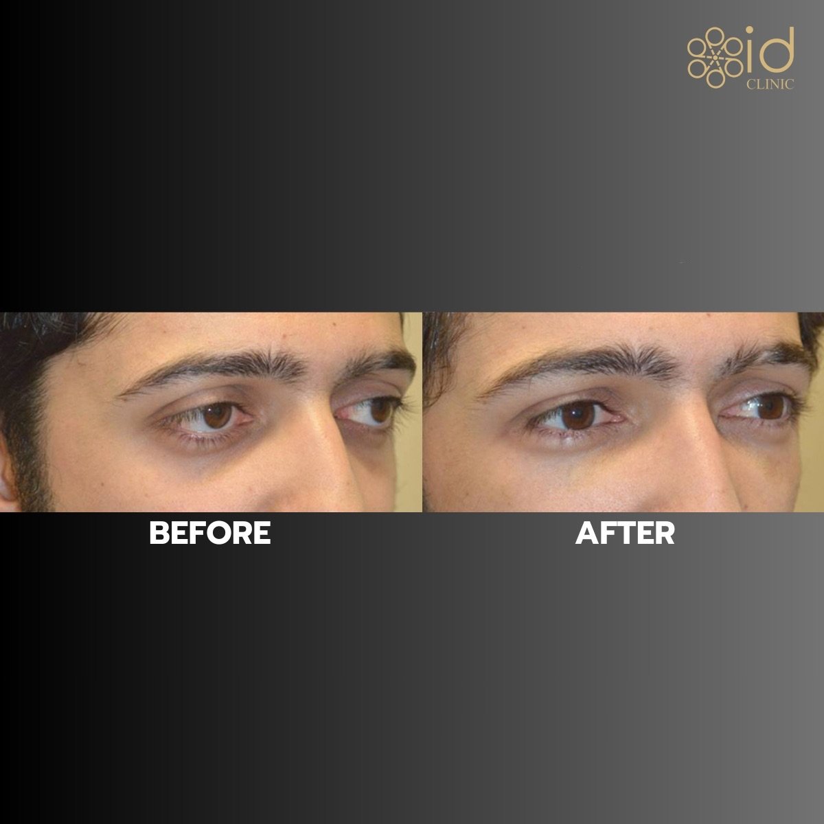 Resultados de blefaroplastia superior antes y después en ID Clinic Bangkok, mirada mejorada