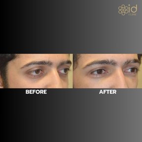 Before and after upper eyelid surgery results at ID Clinic Bangkok, improved eye appearance