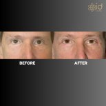 Before and after upper eyelid surgery result at ID Clinic Bangkok, rejuvenated eye appearance