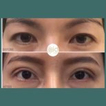 Before and after upper eyelid surgery results at ID Clinic Bangkok, improved eyelid contour