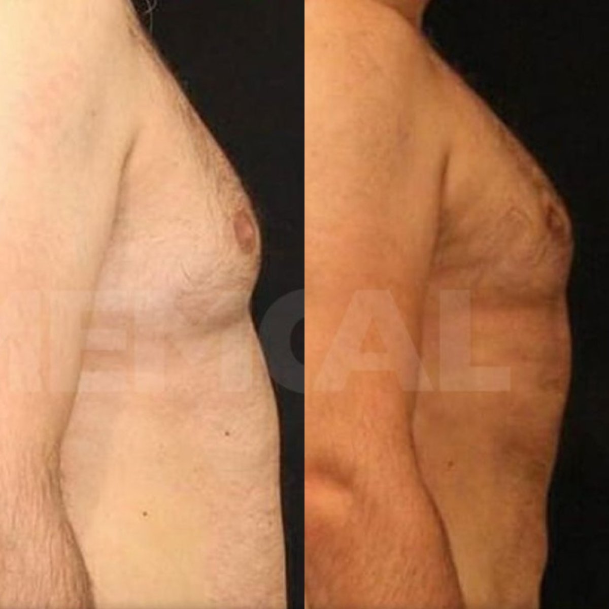 Resultados antes y después de cirugía de ginecomastia en Memorial Göztepe Hospital, contorno torácico