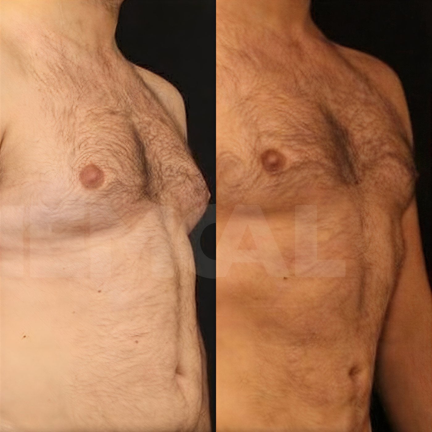 Resultados antes y después de ginecomastia en Memorial Göztepe Hospital, contorno masculino