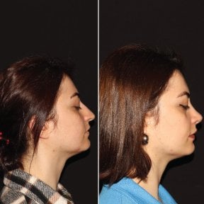 Vorher-nachher-Ergebnis der geschlossenen Rhinoplastik bei Private Yüzyıl Hospital, verbesserte Nasenform