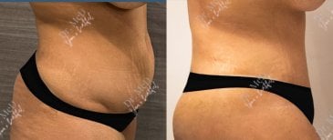 Vorher-nachher-Liposuktionsergebnis bei Dr. MED, sichtbare Bauchkontur-Verbesserung