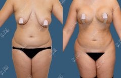 Vorher-nachher-Liposuktionsergebnis bei Dr. MED, sichtbare Körperkonturierung