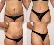 Vorher-nachher-Liposuktionsergebnisse bei Dr. MED – sichtbare Taillen- und Bauchkontur