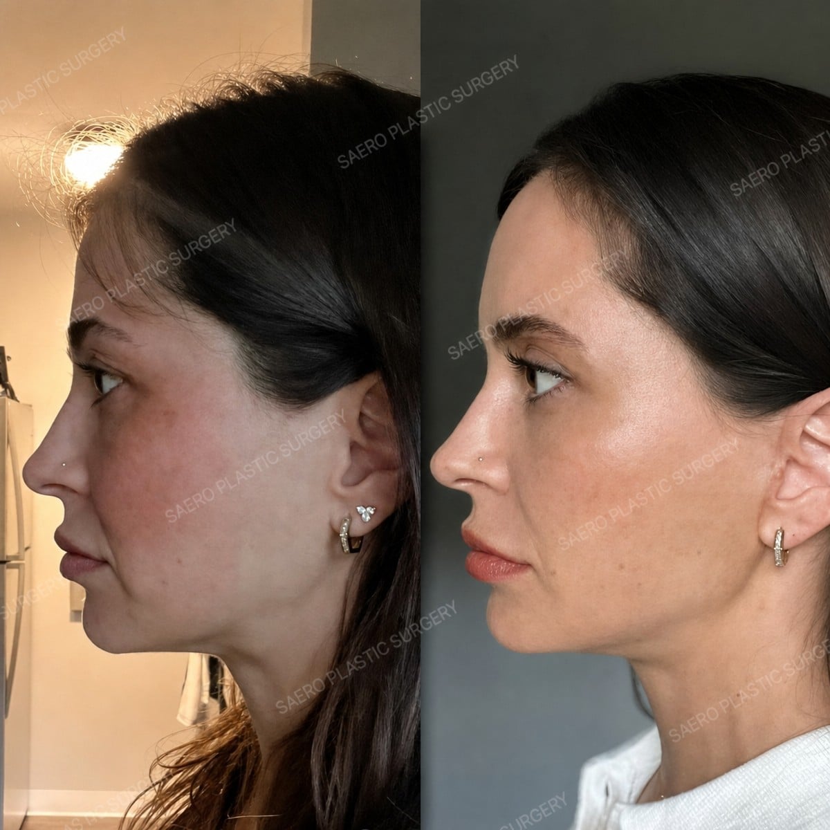 نتائج شد الوجه المصغر قبل وبعد في SAERO Plastic Surgery، تحسين خط الفك