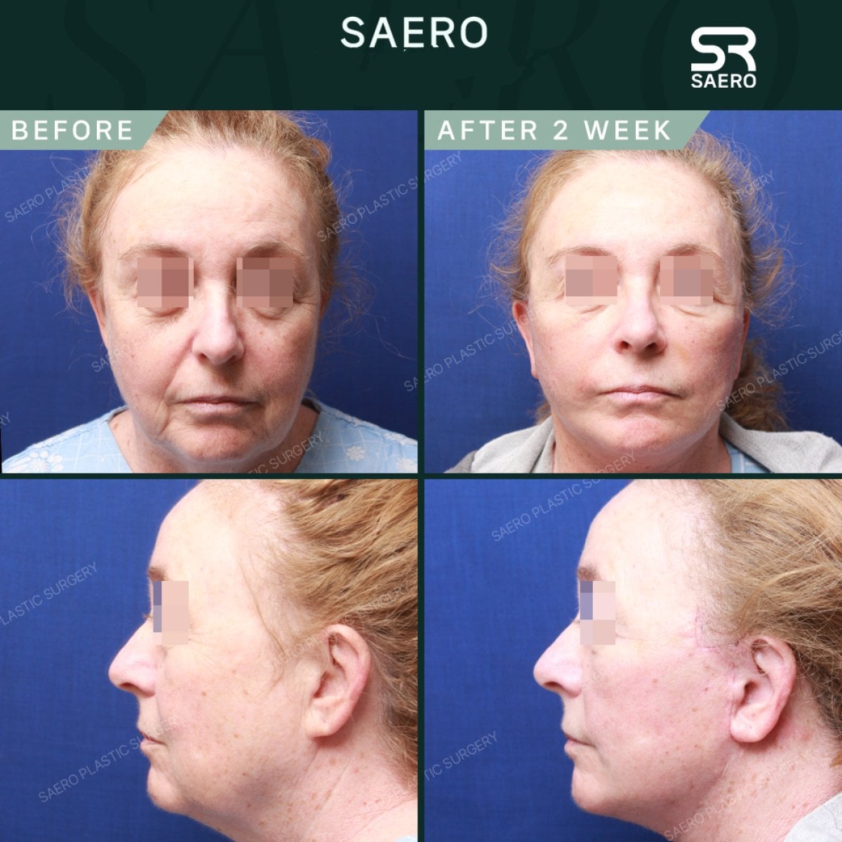 Resultados de lifting facial antes y después en SAERO Plastic Surgery, rejuvenecimiento en 2 semanas