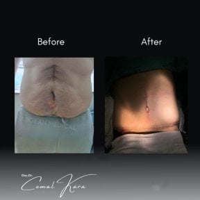 Vorher-nachher-Ergebnisse der Bauchdeckenstraffung bei Assoc.Prof.Dr.Cemal Kara / Medical Park İzmir Hospital