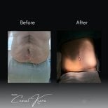 Vorher-nachher-Ergebnisse der Bauchdeckenstraffung bei Assoc.Prof.Dr.Cemal Kara / Medical Park İzmir Hospital
