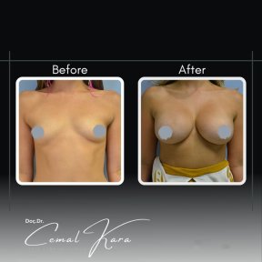 نتائج تكبير الثدي قبل وبعد في Assoc.Prof.Dr.Cemal Kara / Medical Park İzmir