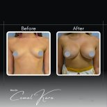 نتائج تكبير الثدي قبل وبعد في Assoc.Prof.Dr.Cemal Kara / Medical Park İzmir