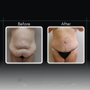 Efekty przed i po plastyce brzucha w Assoc.Prof.Dr.Cemal Kara / Medical Park İzmir Hospital