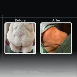 Resultados de abdominoplastia antes y después en Assoc.Prof.Dr.Cemal Kara / Medical Park İzmir Hospital