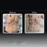 Resultados de abdominoplastia antes y después en Assoc.Prof.Dr.Cemal Kara / Medical Park İzmir Hospital