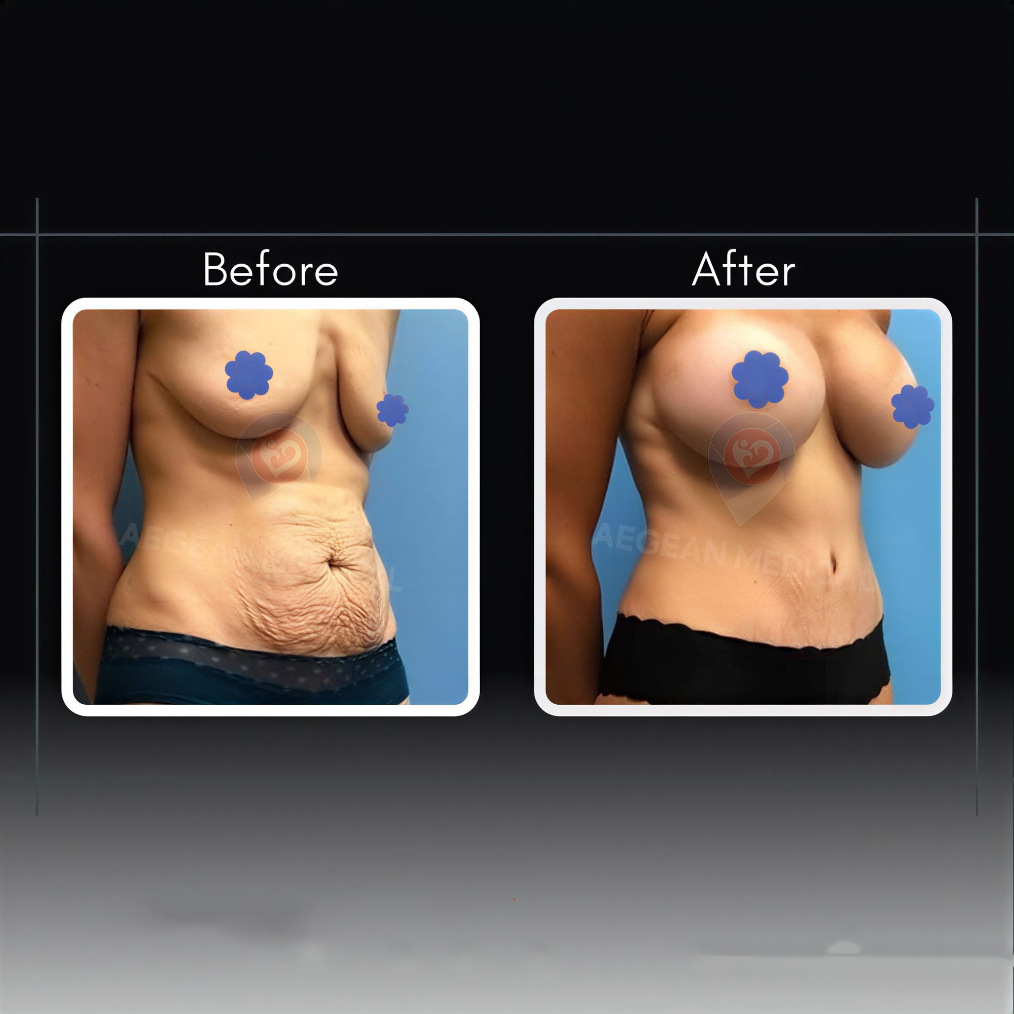 Resultados de abdominoplastia antes y después en Assoc.Prof.Dr.Cemal Kara / Medical Park İzmir Hospital